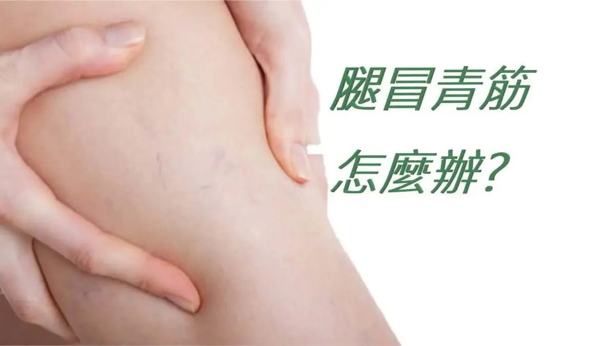 腿部可見表淺青筋的衛教圖，圖中文字為腿冒青筋怎麼辦。